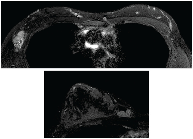 Top, Axial T2-weighted magnetic resonance imaging (MRI) at the level of the axilla. Bottom, Axial postcontrast T1 fat-saturated MRI of the right breast.