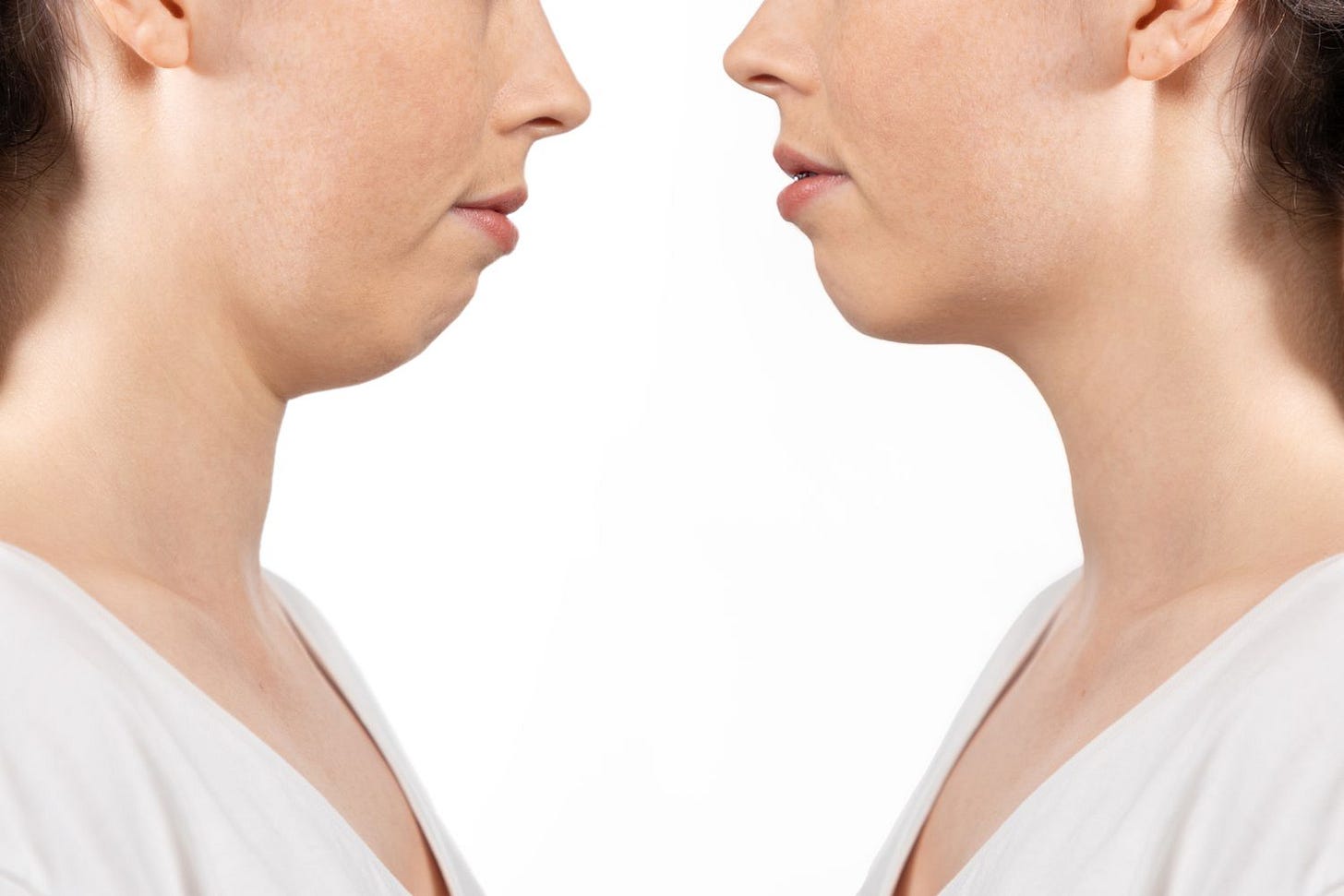 Receding Chin: Causes, Pictures, Treatment
