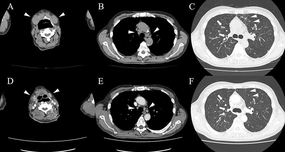 Computed-tomography-findings-before-and-after-resuming-prednisolone.