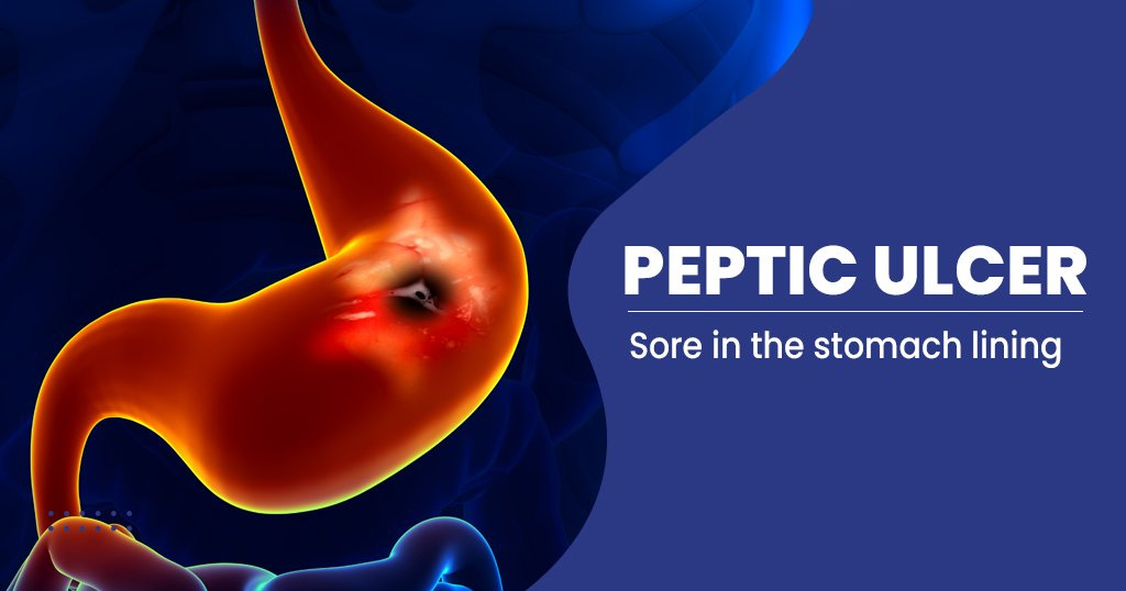 Peptic Ulcer Disease - Causes, Symptoms, Treatment , And Preventions