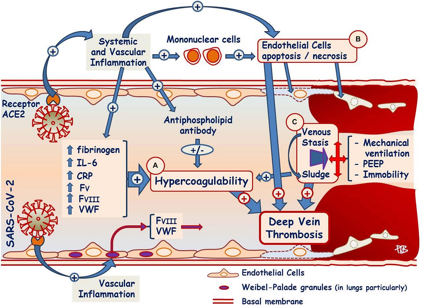 Infographic of pathophysiology underlying deep vein thrombosis in COVID patients