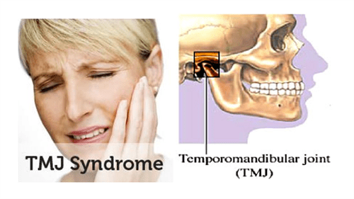 TMJ Disorders | Dr. Sarah Vakkalanka | Huntington Beach