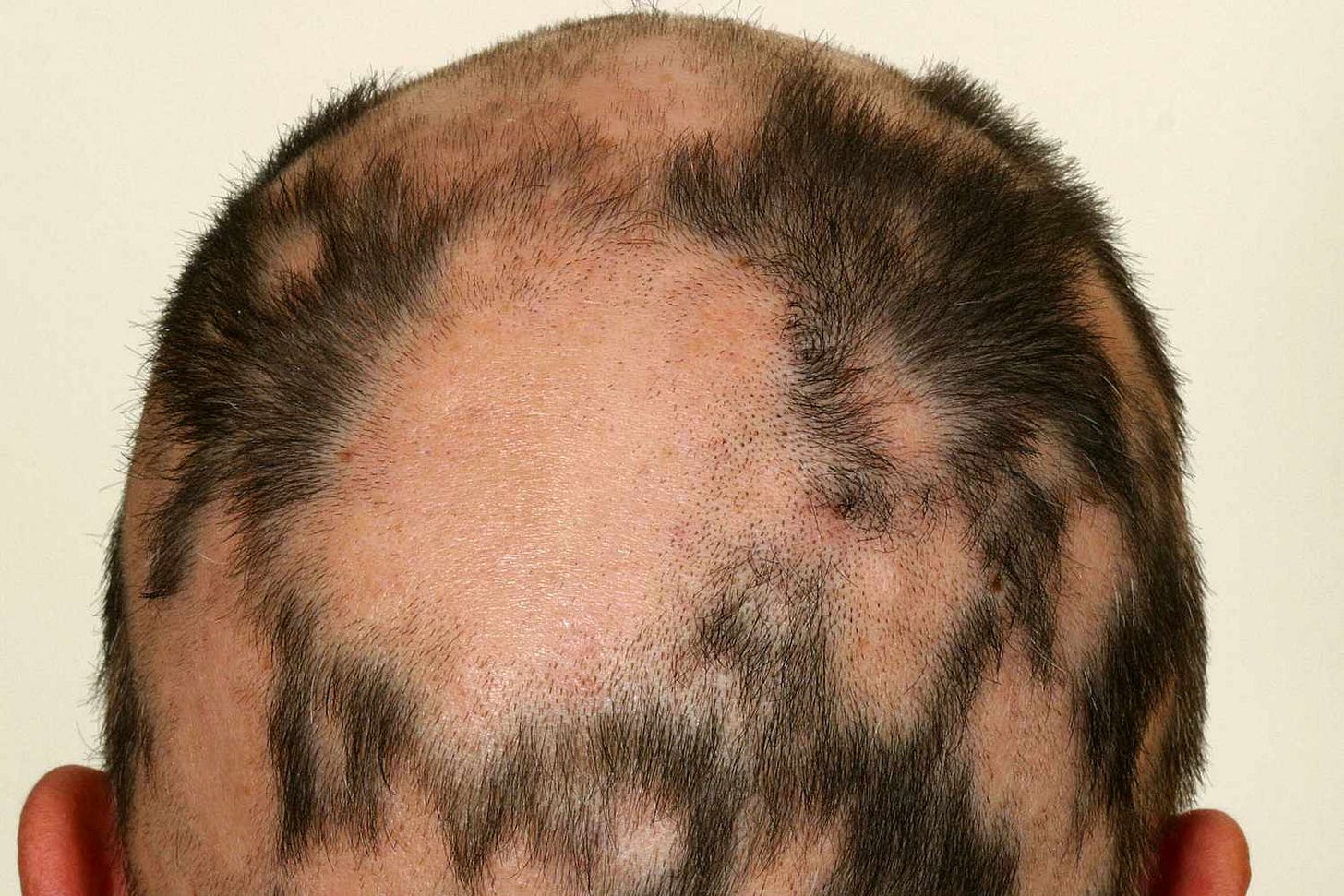 Alopecia Areata: Treatment, Symptoms, Causes, and More