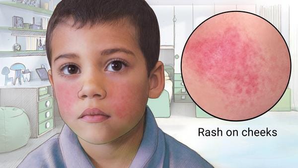 Young boy in his bedroom with a distinctive red rash on his cheeks. Close-up of the facial rash.