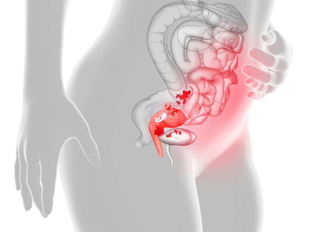 Tudo sobre endometriose: exames, sintomas e tratamentos