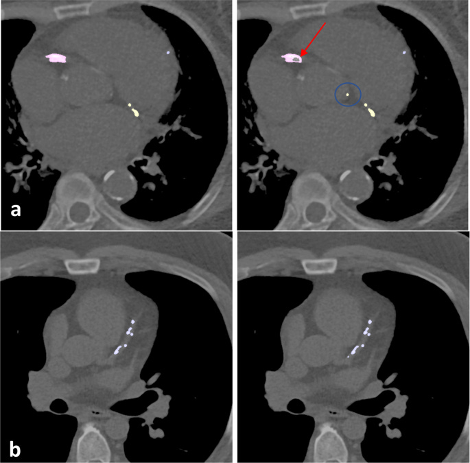 Automated coronary calcium scoring using deep learning with multicenter  external validation | npj Digital Medicine