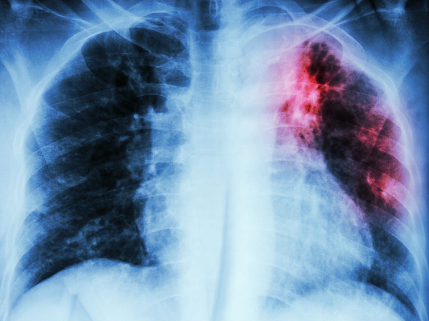 Tuberculosis: The world's deadliest infectious disease is on the rise in  the UK | The Independent