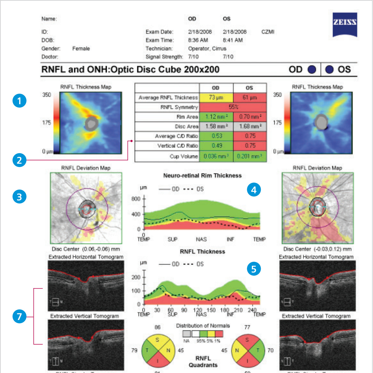 An image displaying information collected via an eye exam. There are various measurements, including "Neuro-retinal Rim Thickness" and "RNFL Thickness." There are a few colorful images and charts.