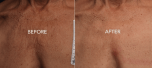 Laser Therapy For A Firmer Chest And Décolleté