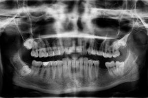 Dental xray of missing tooth