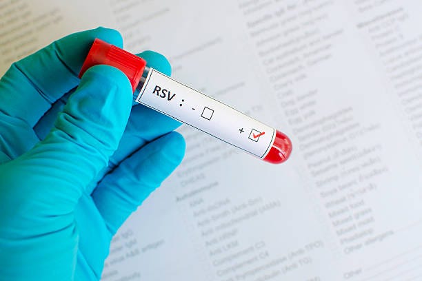 respiratory syncytial virus (rsv) positive - respiratory syncytial bildbanksfoton och bilder