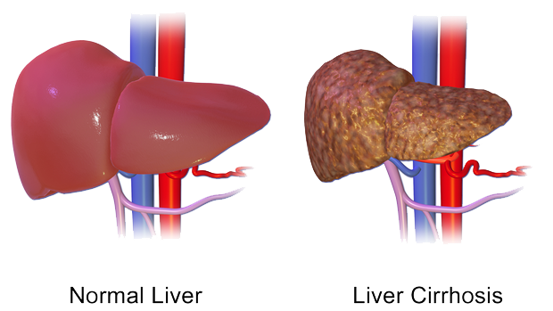 Liver Cirrhosis 620