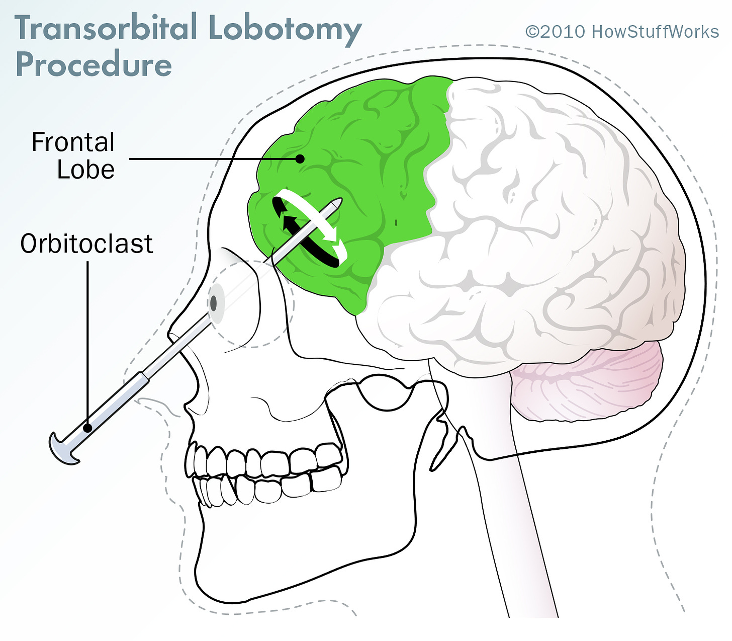 How Lobotomies Work | HowStuffWorks