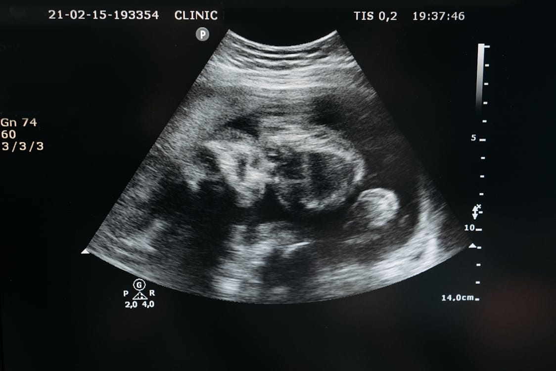 Free Ultrasound of an Unborn Child Stock Photo