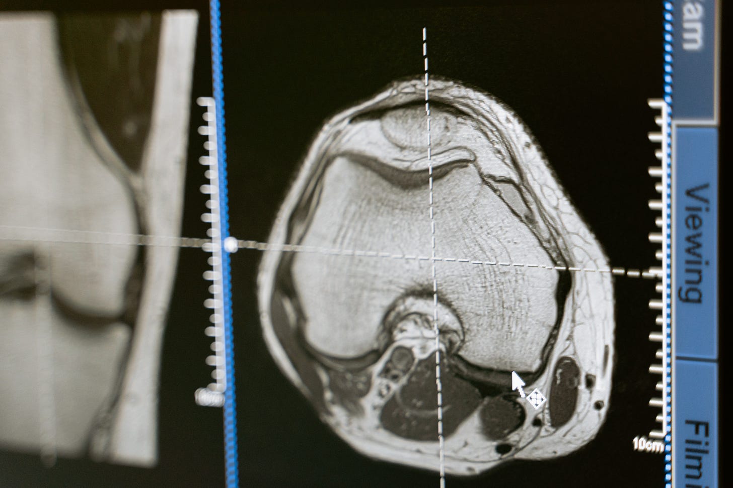 MRI of a knee cross-section, MRI, Knee, orthopedic, orthopaedic, joint, injury