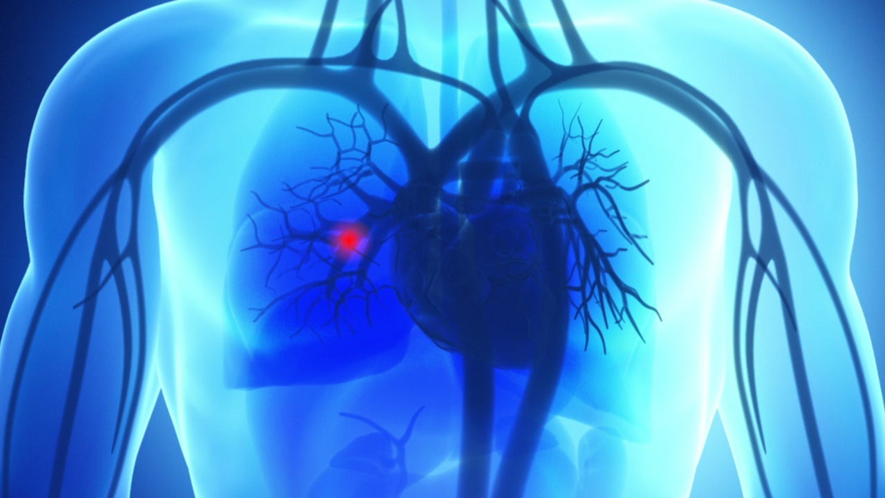 Pulmonary Embolism | Johns Hopkins Medicine