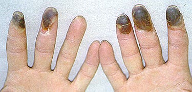 Buerger's Disease : Johns Hopkins Vasculitis Center