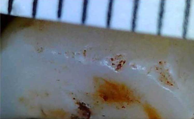 Figure 2 from Towle et al showing dental chips