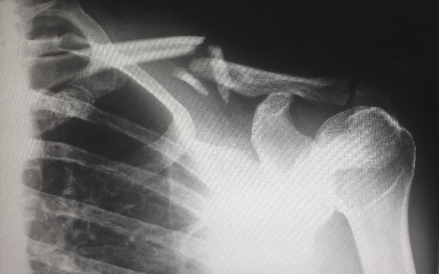 An x-ray showing ribs and a shoulder socket