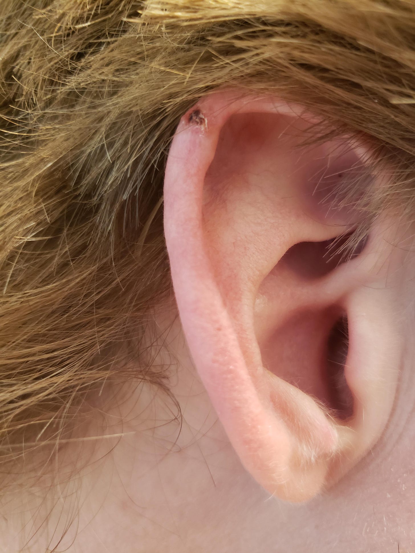 r/mildlyinteresting - I nicked my upper ear cartilage over 1 month ago with electric clippers while trimming my hair