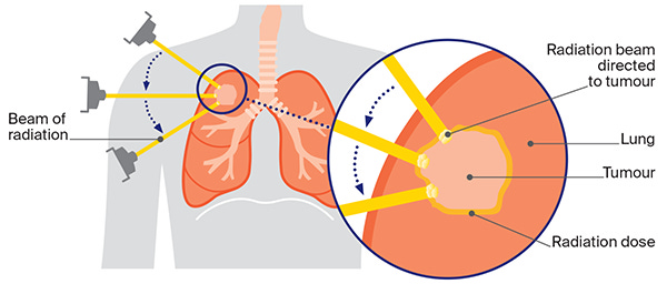 Radiation therapy for Lung Cancer | Cancer Council NSW