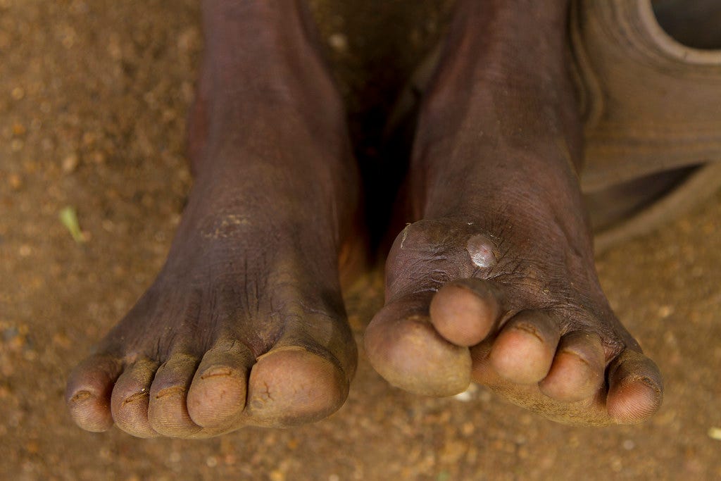 A person with Guinea Worm | A person with Guinea Worm at the… | Flickr