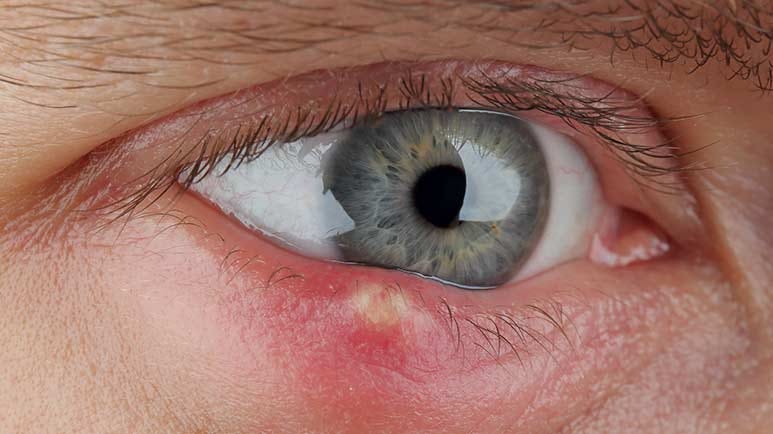 how to get rid of a stye