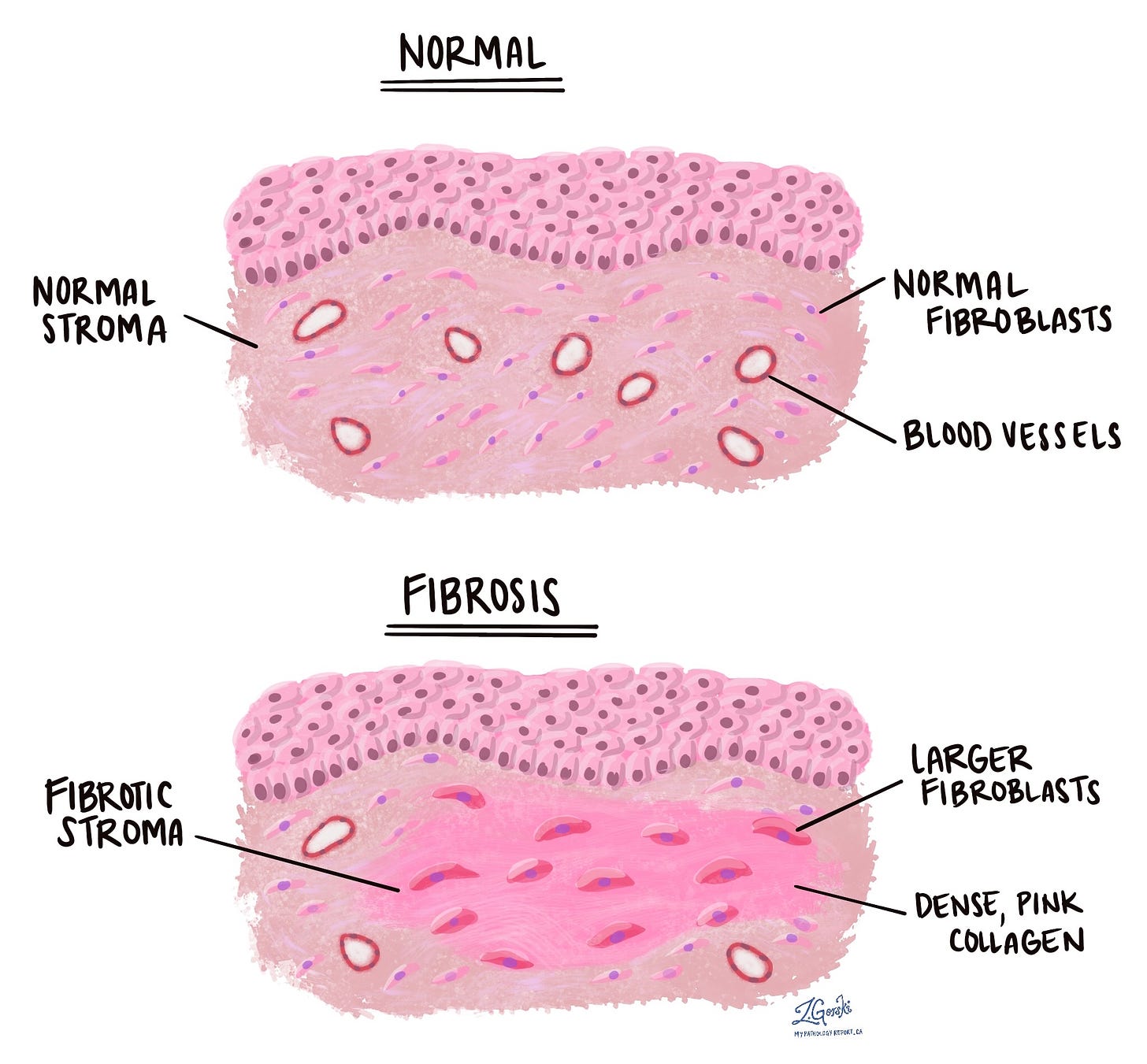 Fibrosis | MyPathologyReport.ca