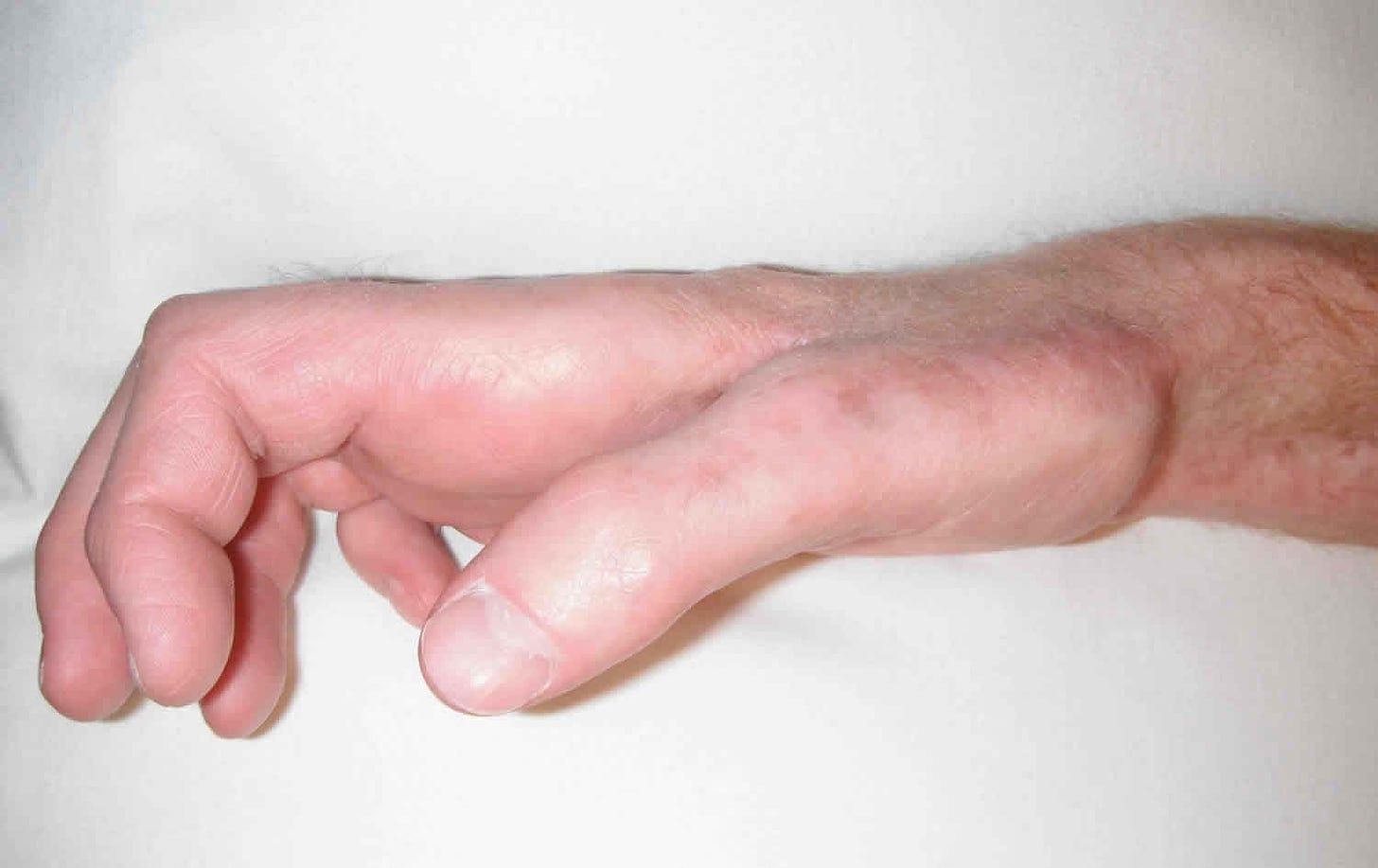 Claw hand causes, signs, symptoms, diagnosis and claw hand treatment