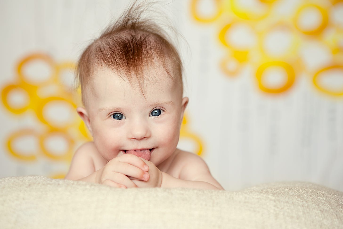 Photo of baby with down syndrome- people with down syndrome