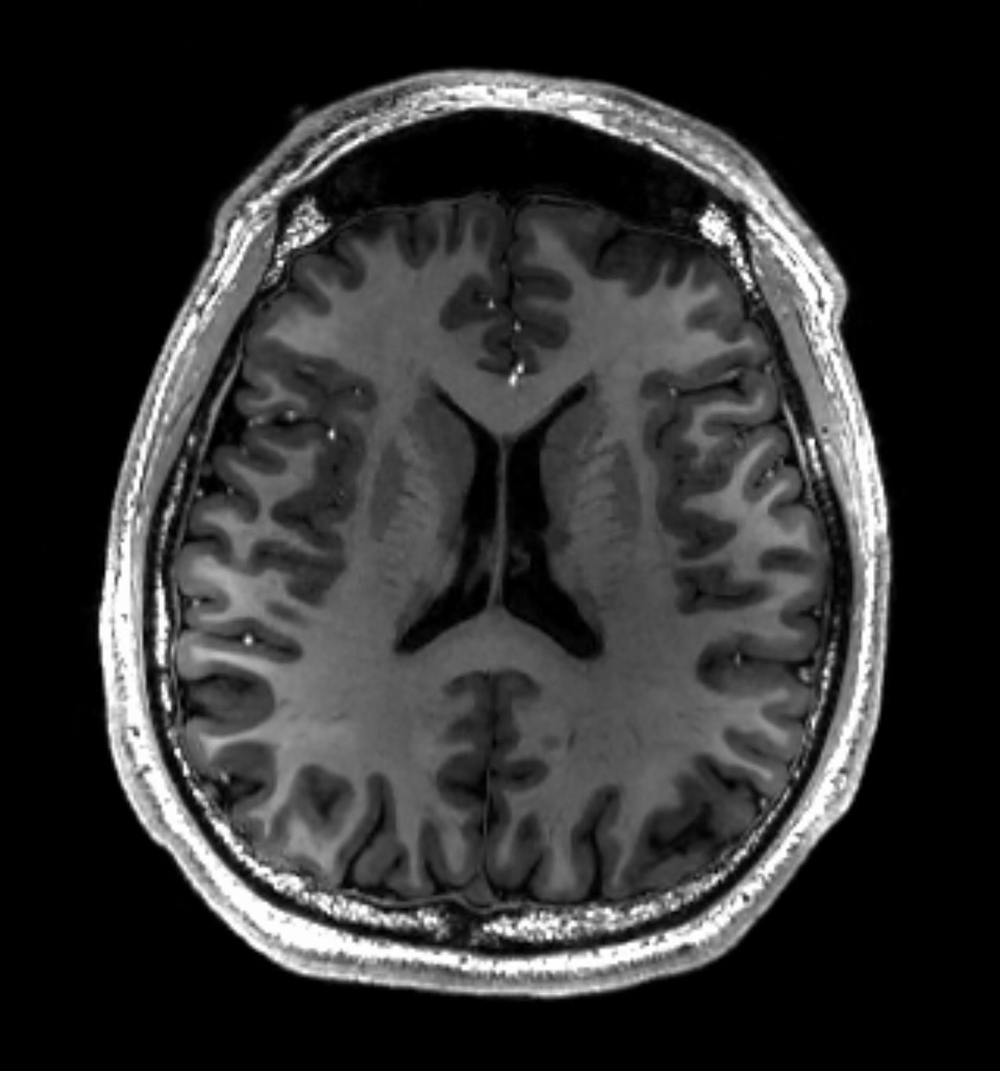 Magnetic resonance imaging of the brain - Wikipedia