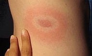 Erythema chronicum migrans - Wikipedia, the free encyclopedia