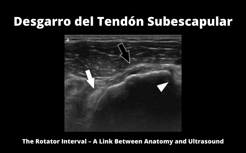 Desgarro Tendon Subescapular.png