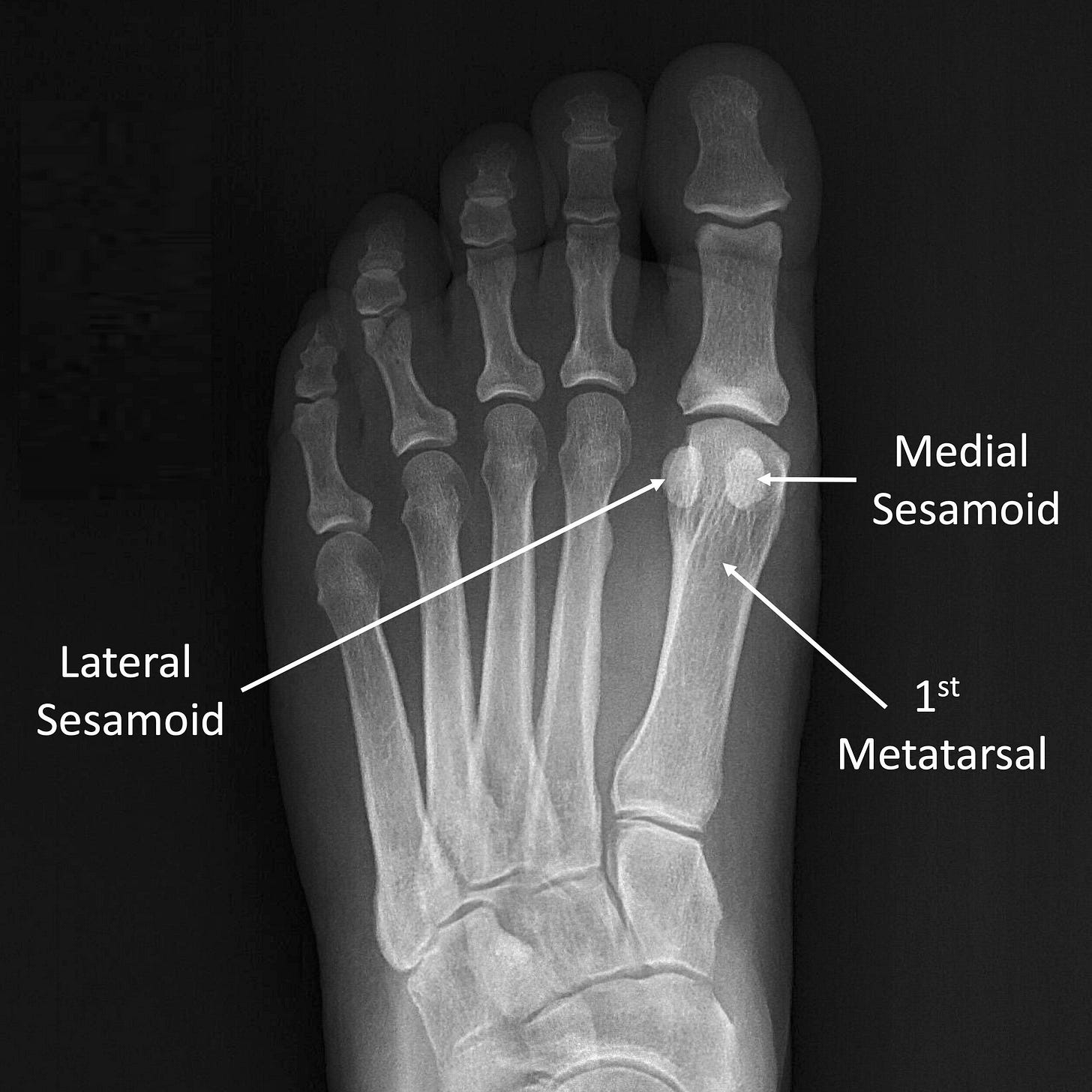 Sesamoiditis — Daniel Bohl, MD | Midwest Orthopaedics at RUSH