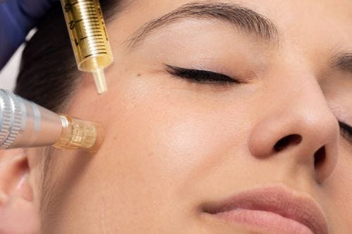 Face shot of woman at micro needle cosmetic treatment session. Face shot of woman having micro needle cosmetic treatment on face.Therapist reducing crow's feet around eyes injecting hormones and proteins. woman microneedling stock pictures, royalty-free photos & images
