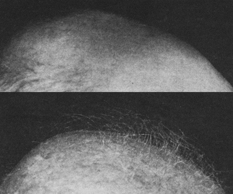 Image: "Scalp of 78-year-old white man bald for 30 years. Top, Clinically scalp appears completely bald, except at sides, but close inspection shows barely perceptible fuzz of tiny, downy hairs. Bottom, Same scalp after nine months of topical testos…