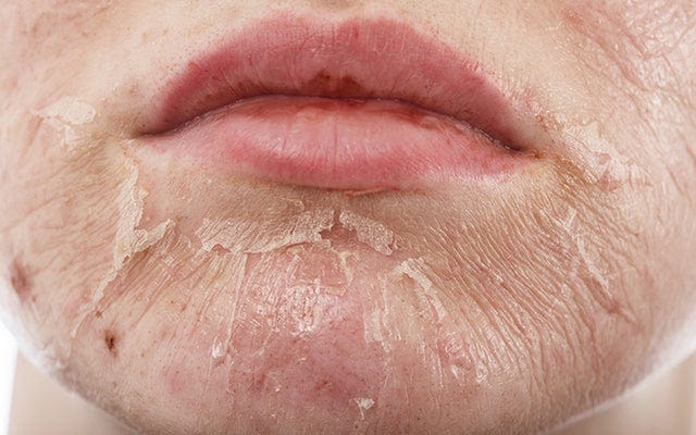 How To Treat Skin Peeling On The Face With Ayurveda? – Vedix