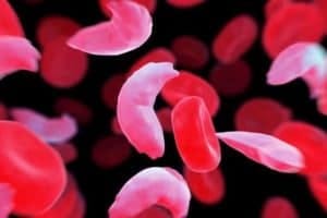 sickle cell blood cells