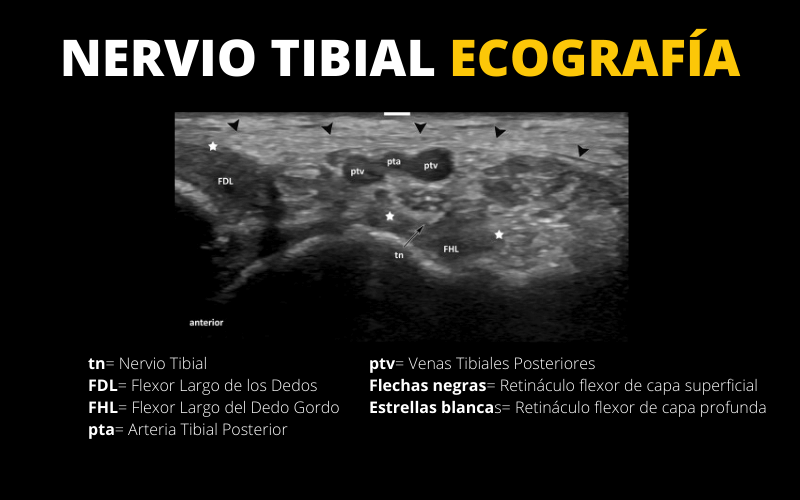 Tibial Ecografia.png