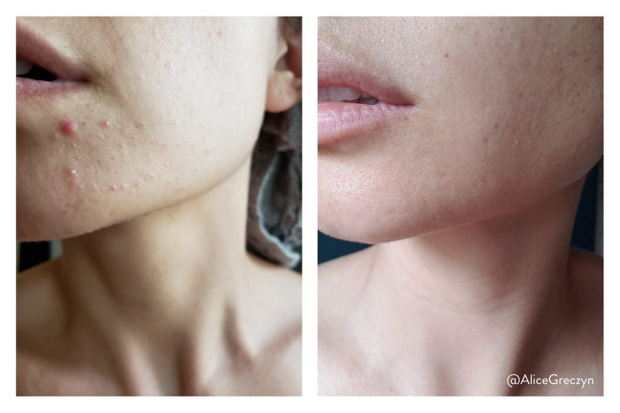 How I Cured My Perioral Dermatitis—The Skin Condition You’ve Never