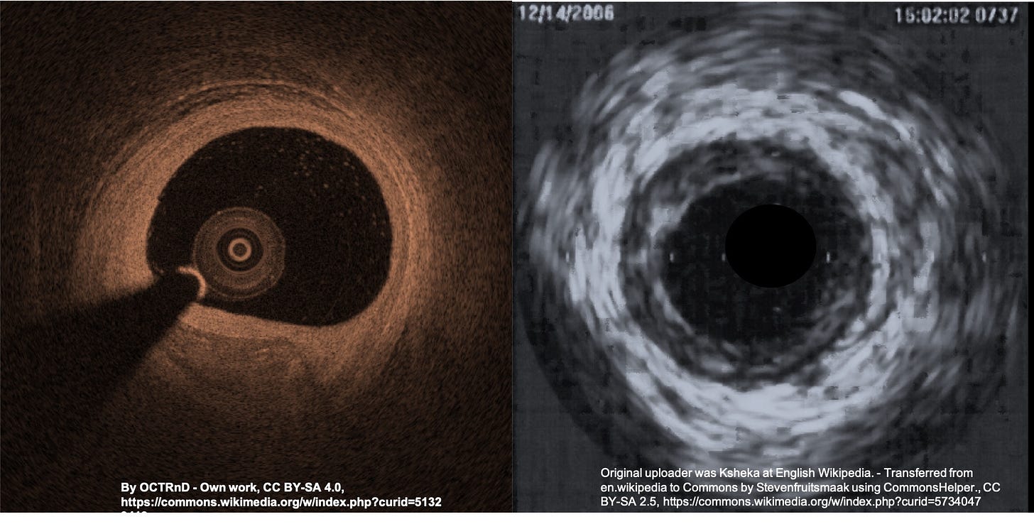 How To Reverse Coronary Artery Disease
