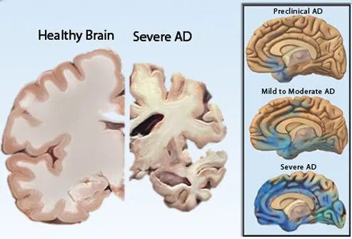 A Multifaceted Treatment Approach To ALZHEIMER’S DISEASE 