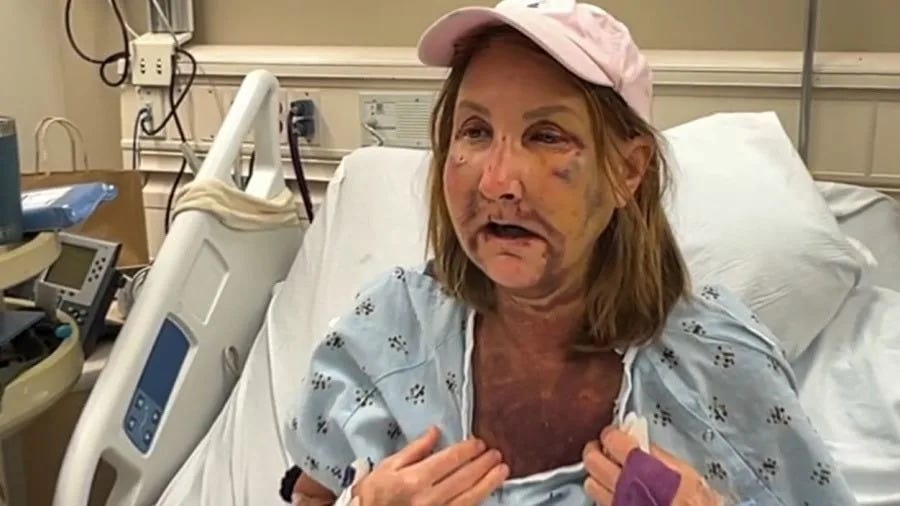Mary Klein, seen with severe injuries and bruising, speaks to KTLA from her hospital bed on April 12, 2024. (KTLA)