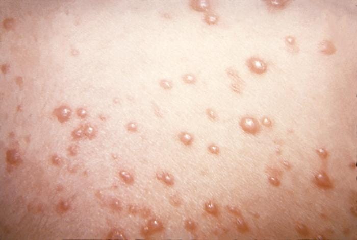 Cayman Islands Health Officials Report Chickenpox Outbreak In School System cayman-islands-health-officials-report-chickenpox-outbreak-in-school-system