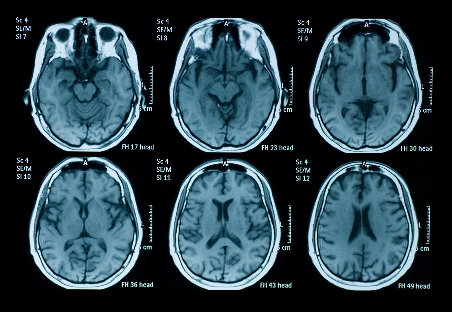 fMRI scan