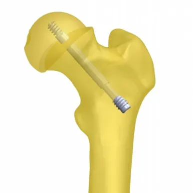 Free-Gliding SCFE Screw System