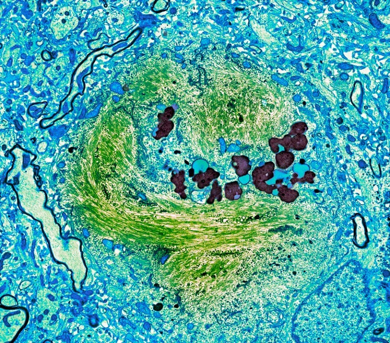 False-coloured transmission electron micrograph of an abnormal aggregate of the protein tau in the brain of a person with Alzheimer's disease