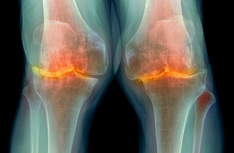 Coloured X-ray of the knees of a patient with severe osteoarthritis, shown in blue and orange colours