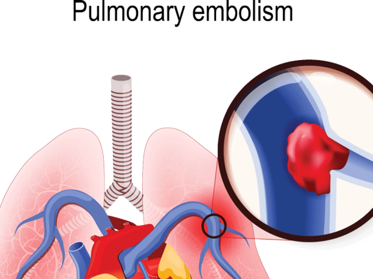 Pulmonary Embolism - Type, Cause, Symptoms, Treatment