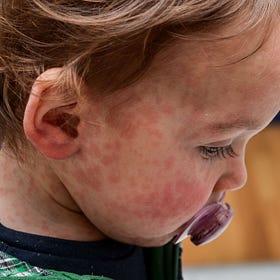 Measles: A Balanced Perspective